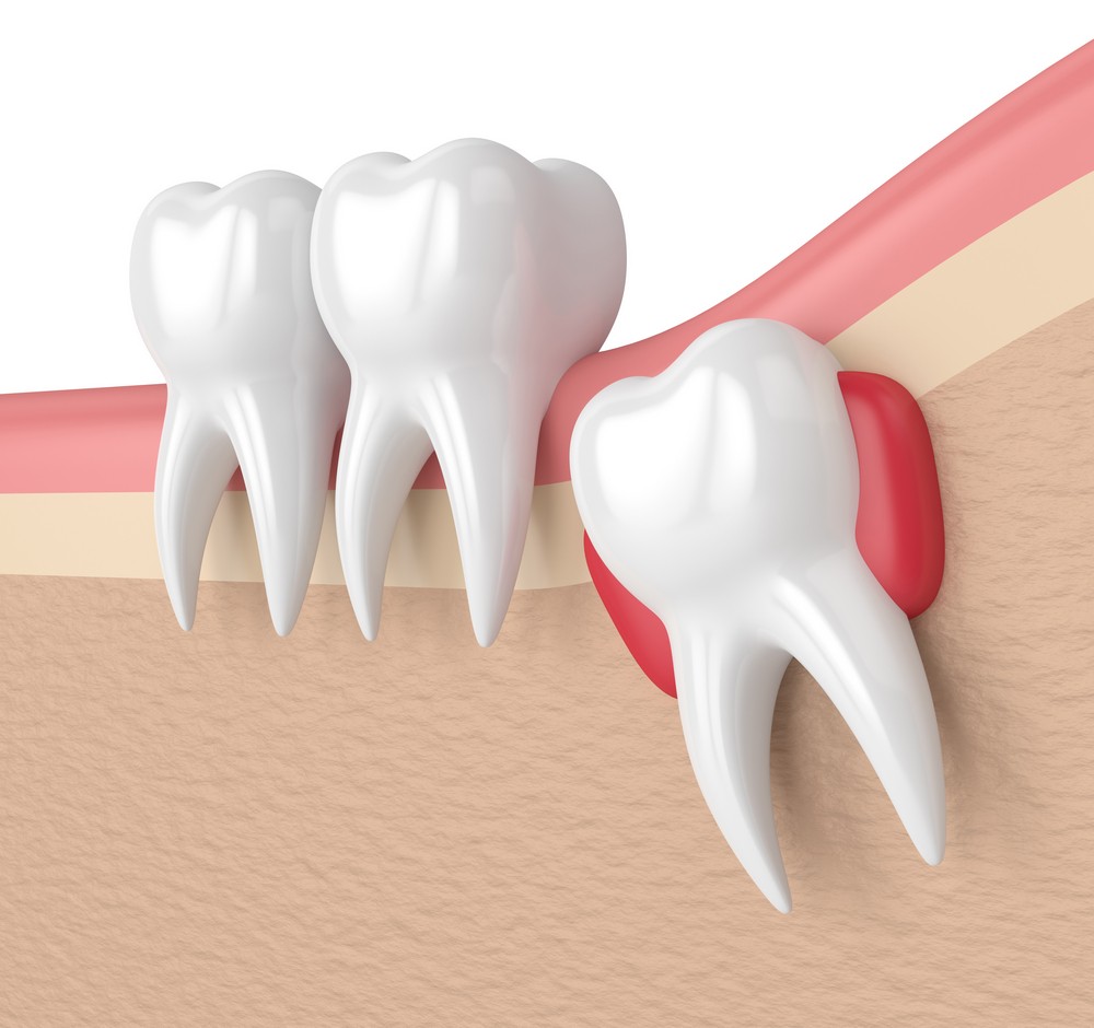 chirurgie dentara targoviste, extractie dentara targoviste, extractie mase minte targoviste pret