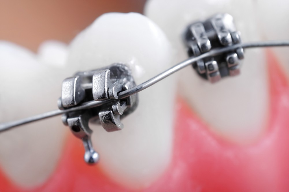 aparat dentar targoviste, ortodontie targoviste, clinica stomatologica rg dental