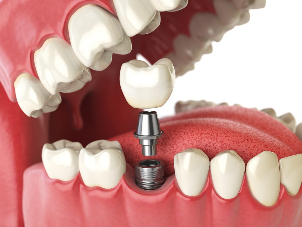 chirurgie dentara targoviste, extractie dentara targoviste, extractie mase minte targoviste pret