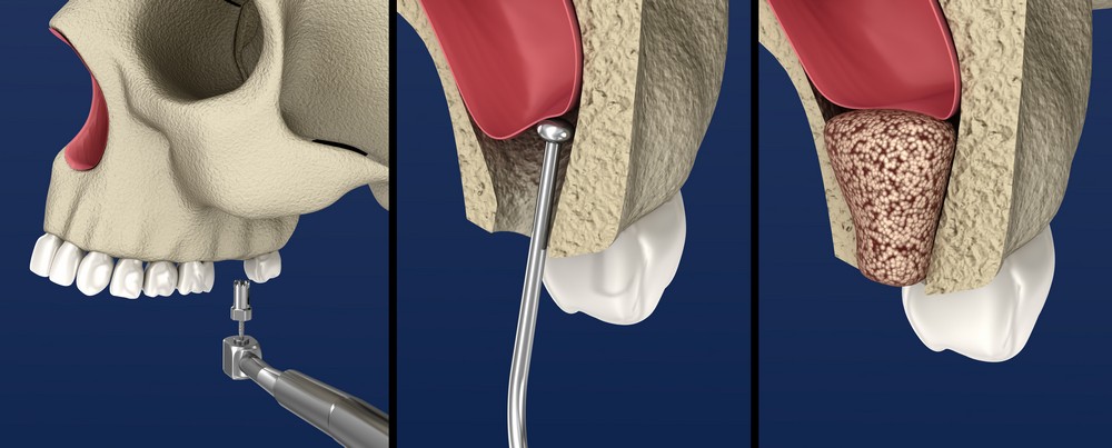 chirurgie dentara targoviste, extractie dentara targoviste, extractie mase minte targoviste pret