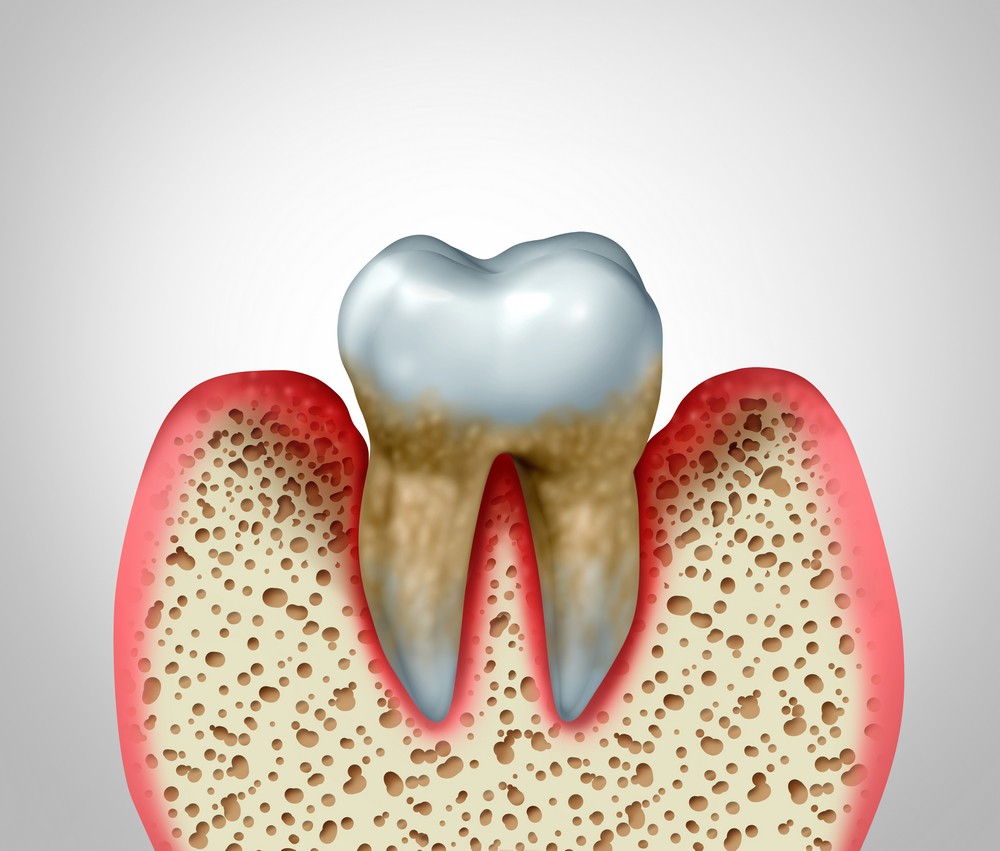 parodontoza targoviste, tratament parodontoza targoviste, rg dental targoviste