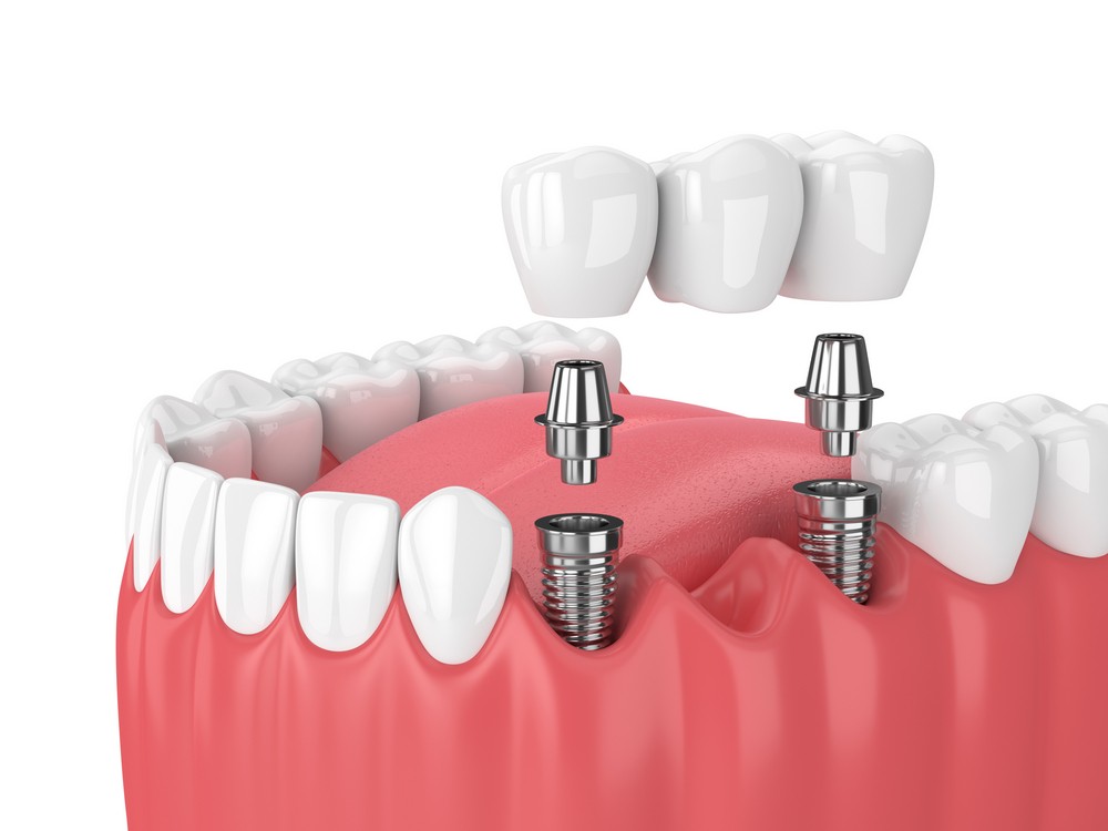 implant dentar targoviste, implantologie targoviste, implant dentar targoviste pret