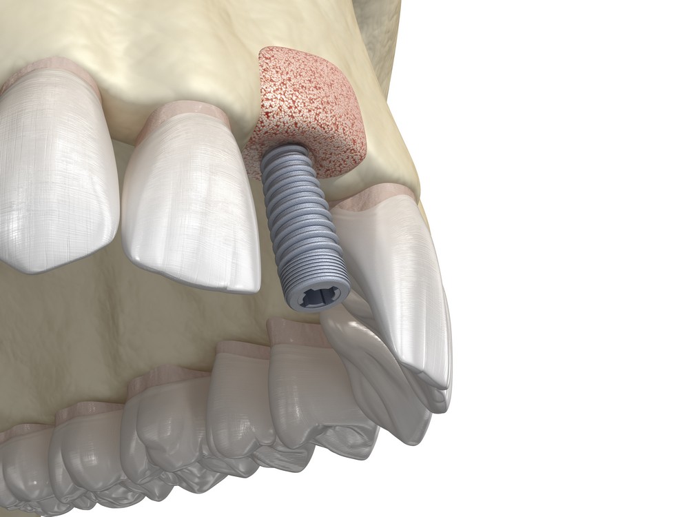 chirurgie dentara targoviste, extractie dentara targoviste, extractie mase minte targoviste pret