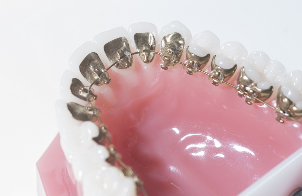 ortodontie targoviste, aparat dentar metalic targoviste, aparat dentar invisalign targoviste pret