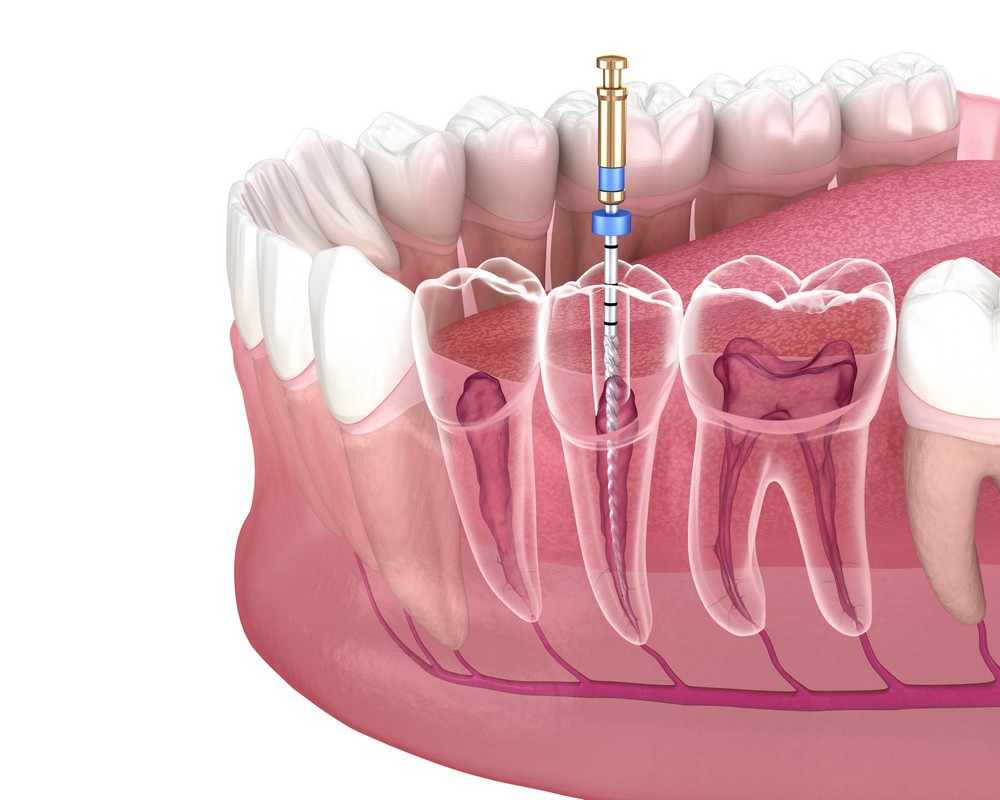 tratament canal targoviste, endodontie targoviste, rg dental targoviste